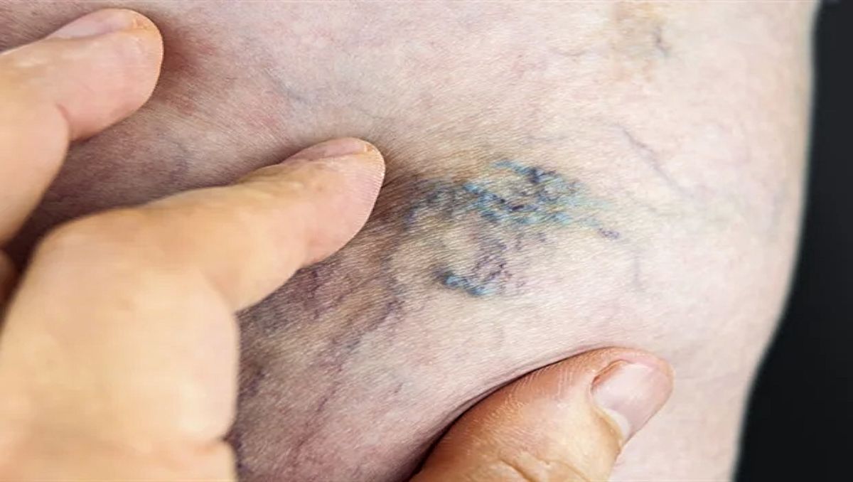A close-up of a varicose vein.