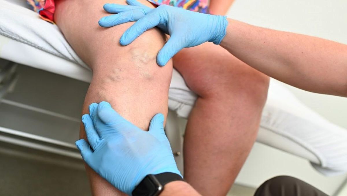 A doctor examining the varicose veins of the patient.